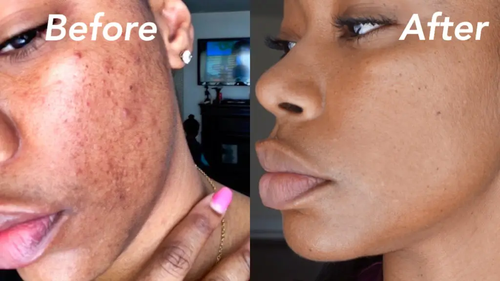 How to remove hyper pigmentation and dark marks from the skin using vitamin c
