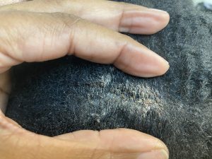 Removing seborrheic dermatitis from the scalp